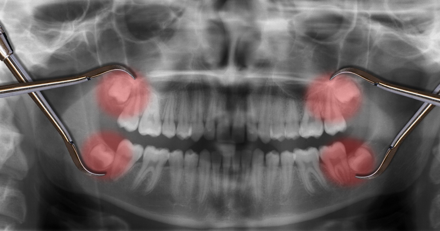 an X-ray showing the four wisdom teeth