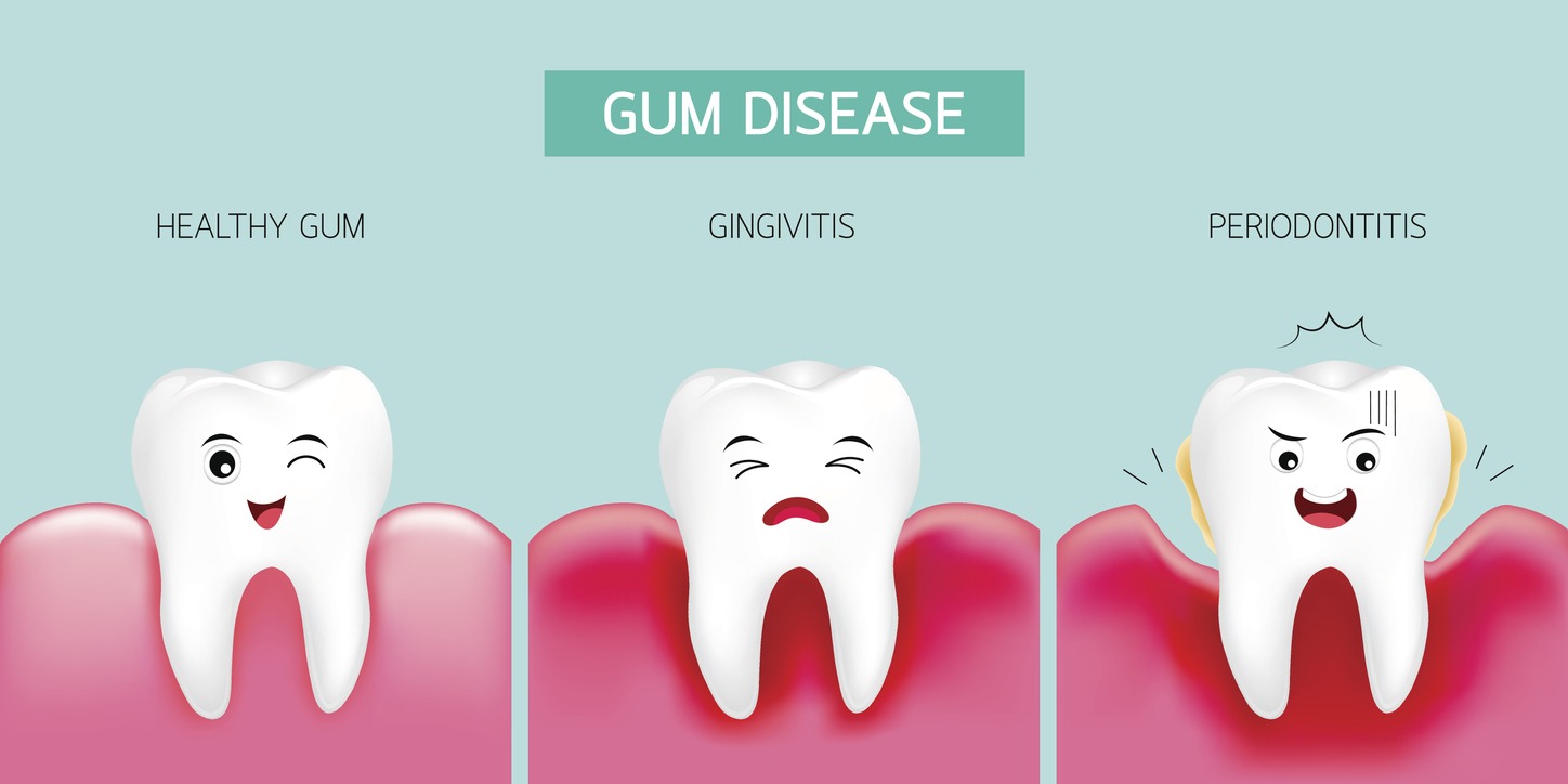 an illustration of different gum diseases