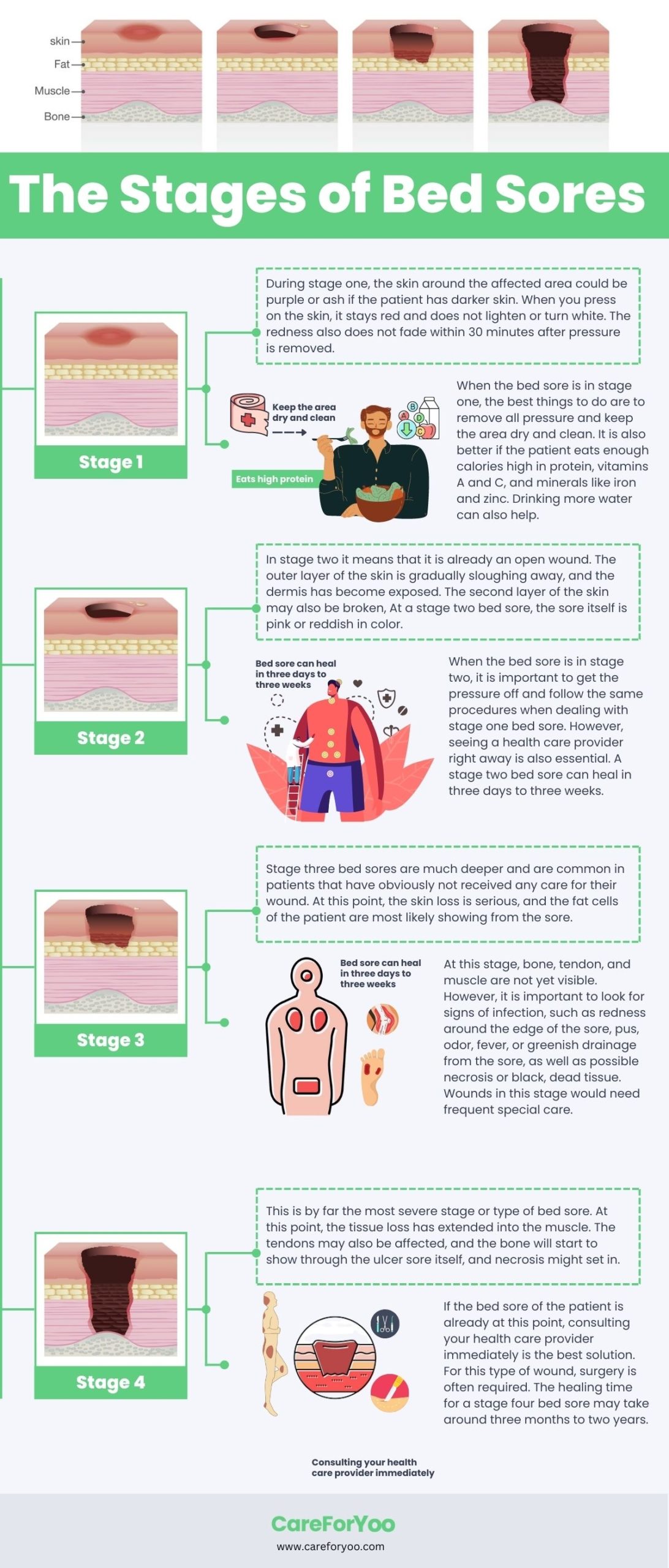 An illustrated guide detailing the different stages and progression of bed sores.