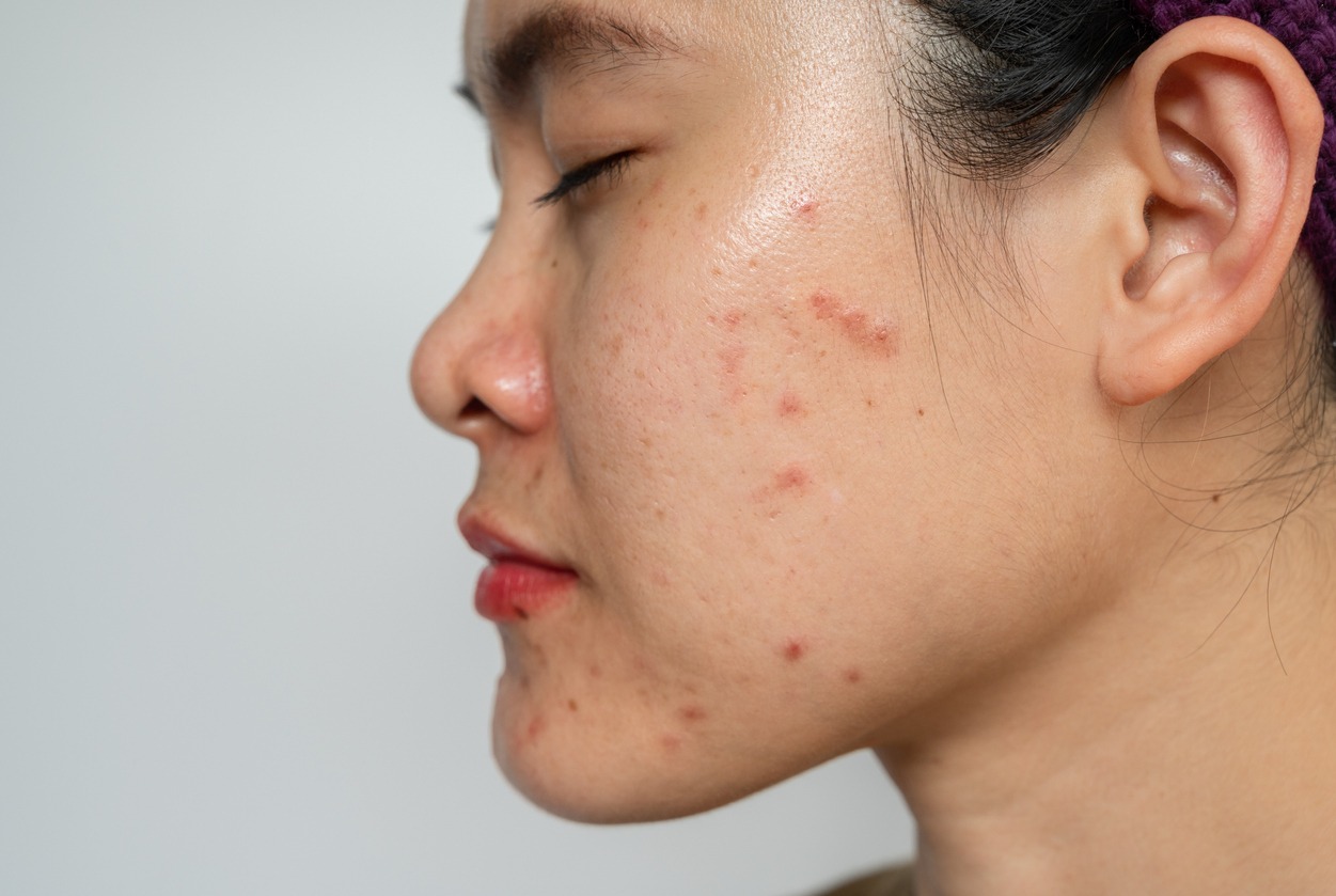 woman with oily and acne-prone skin