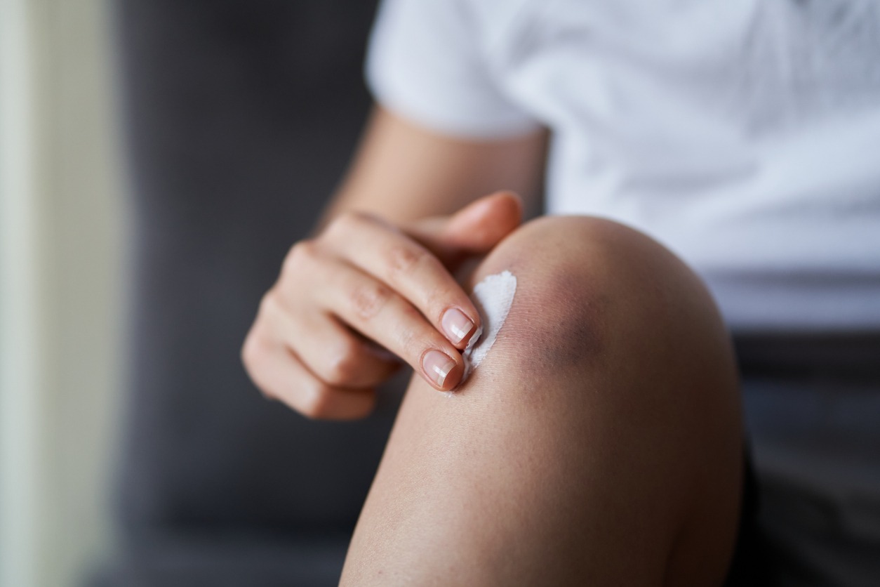 applying pain relief cream on an injured knee