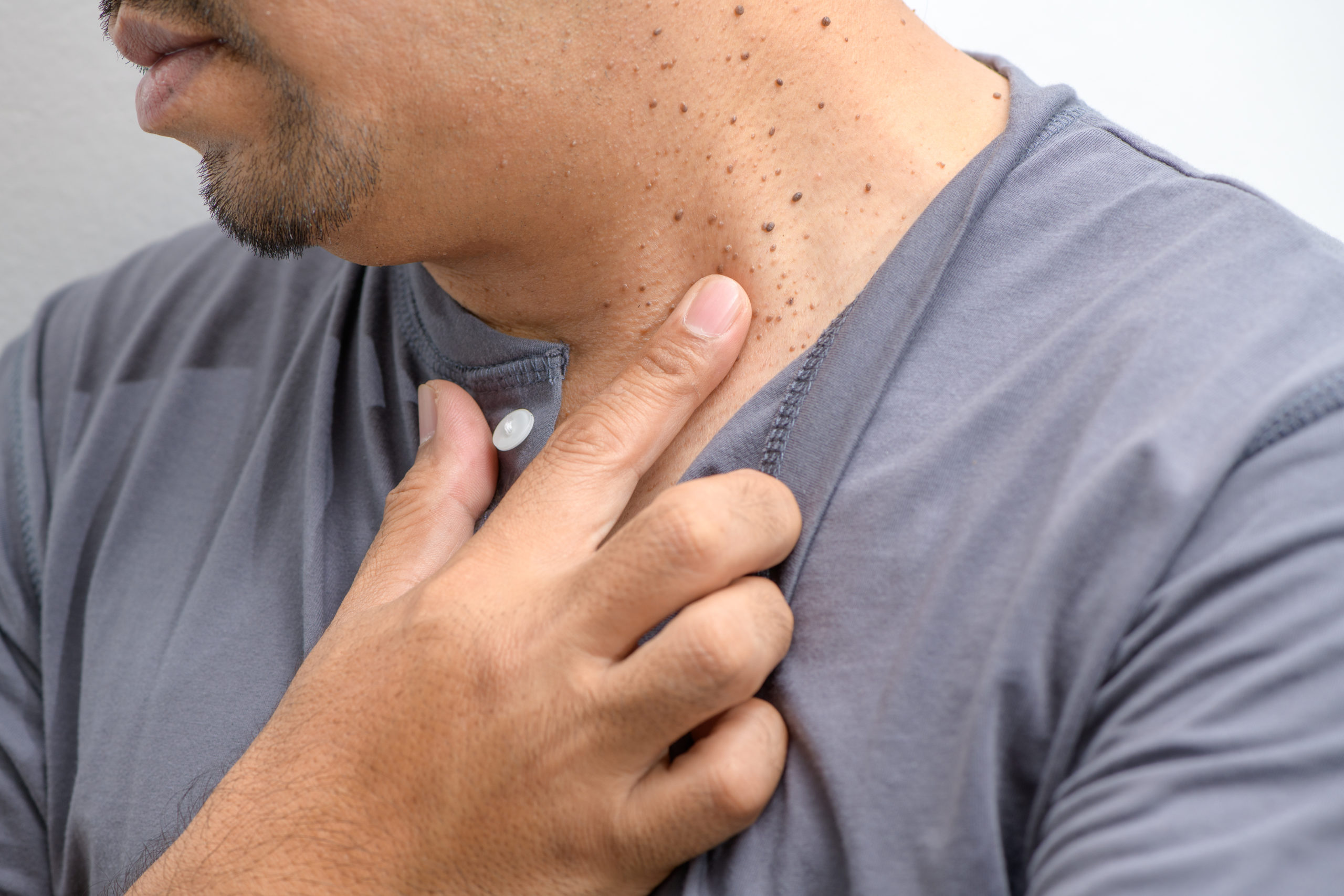 man with a lot of warts on his neck