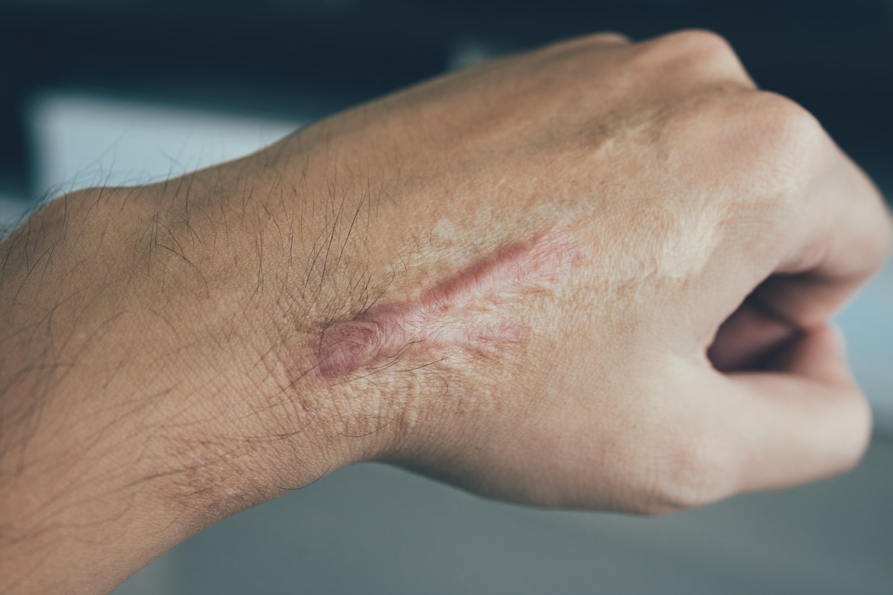 Scar on human skin keloid on hand