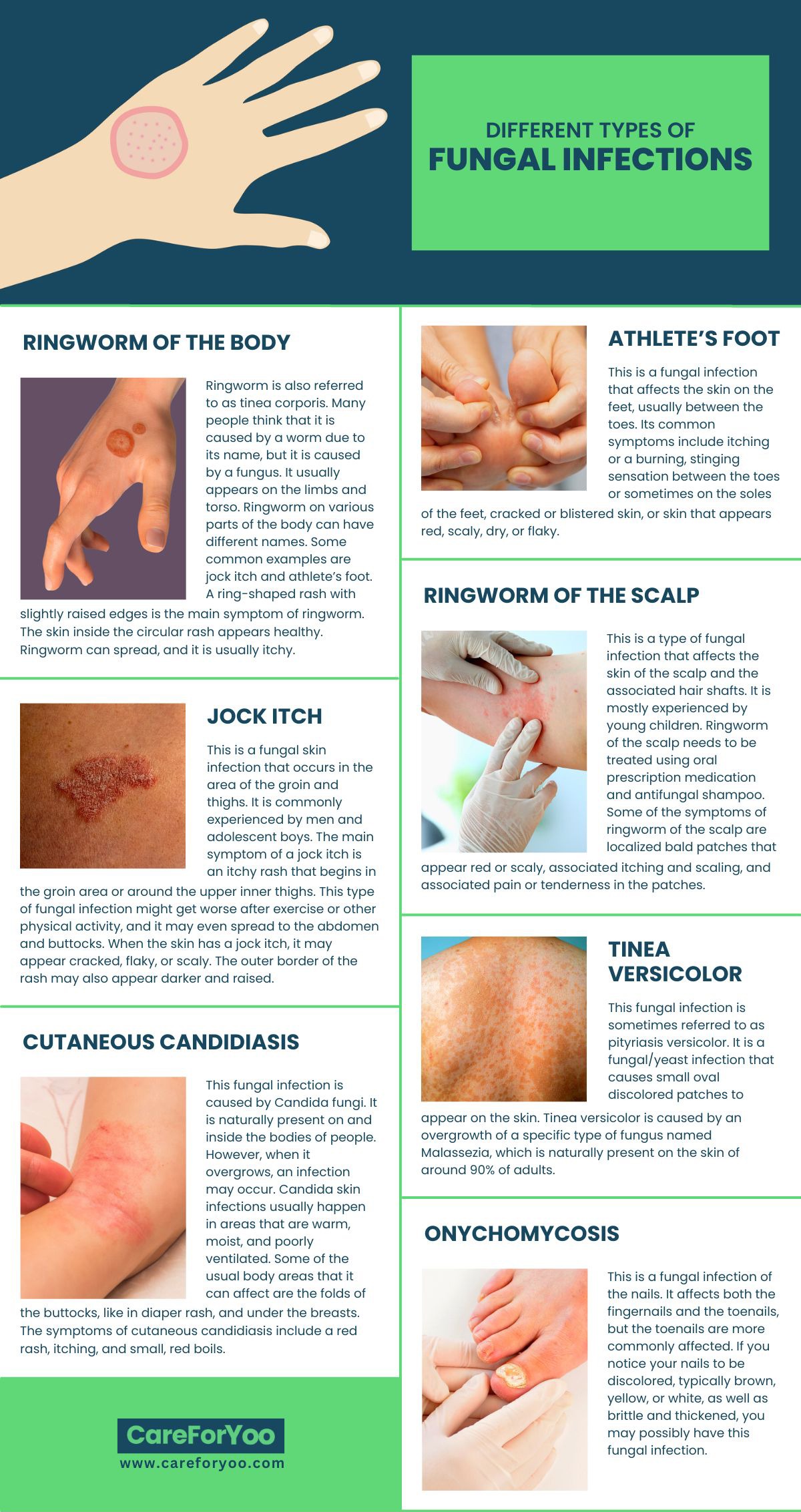 Different Types of Fungal Infections