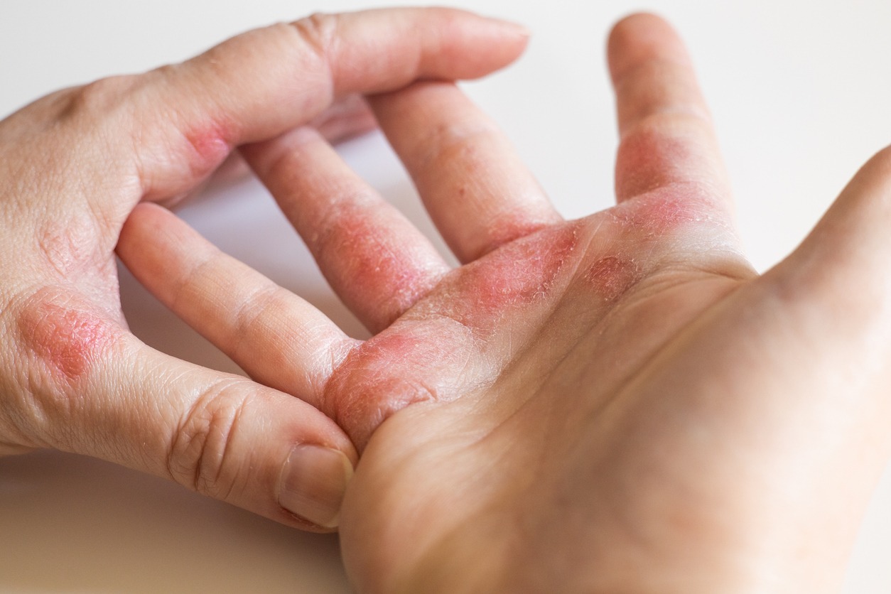 Strong allergic eczema on hands. Red, cracked skin with blisters