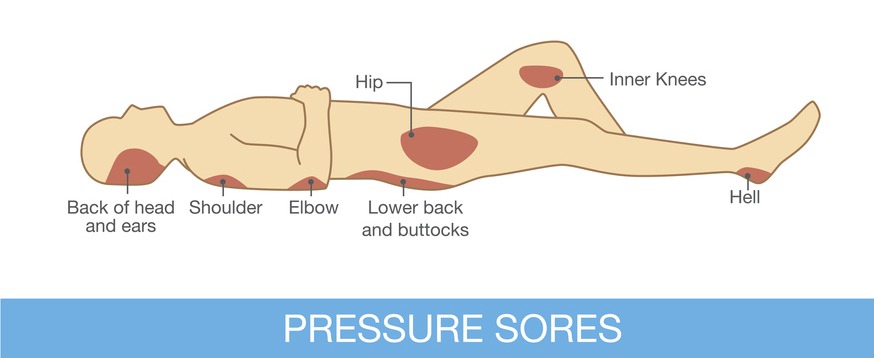 an illustration of pressure sore prone areas