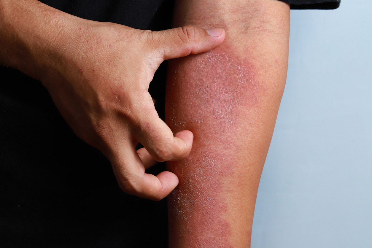 Dermatitis eczema texture of ill human skin