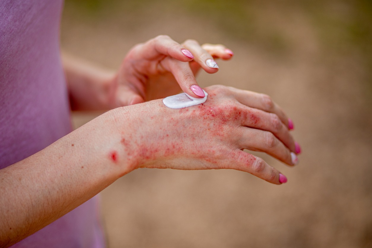 Eczema on the hands. The woman applying the ointment , creams in the treatment of eczema, psoriasis and other skin diseases. Skin problem concept