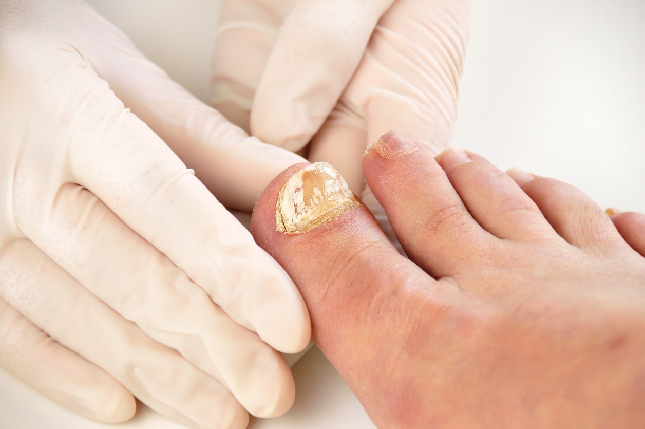 checking the toenail infected by fungus