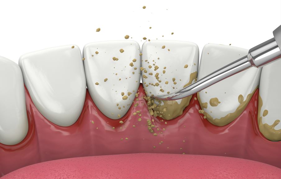 illustration of dental tartar