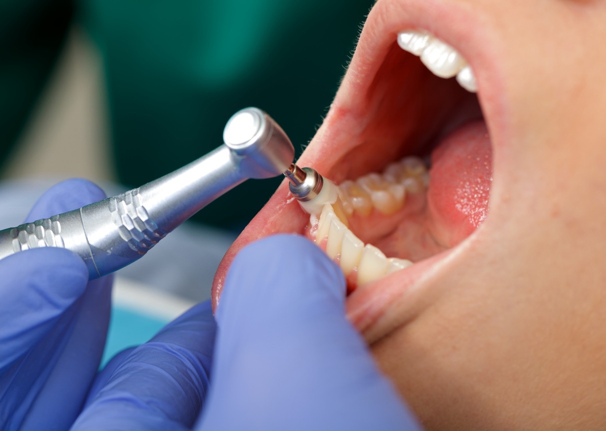 woman undergoing dental cleaning