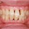 Gum Recession: Causes, Treatments, and Prevention
