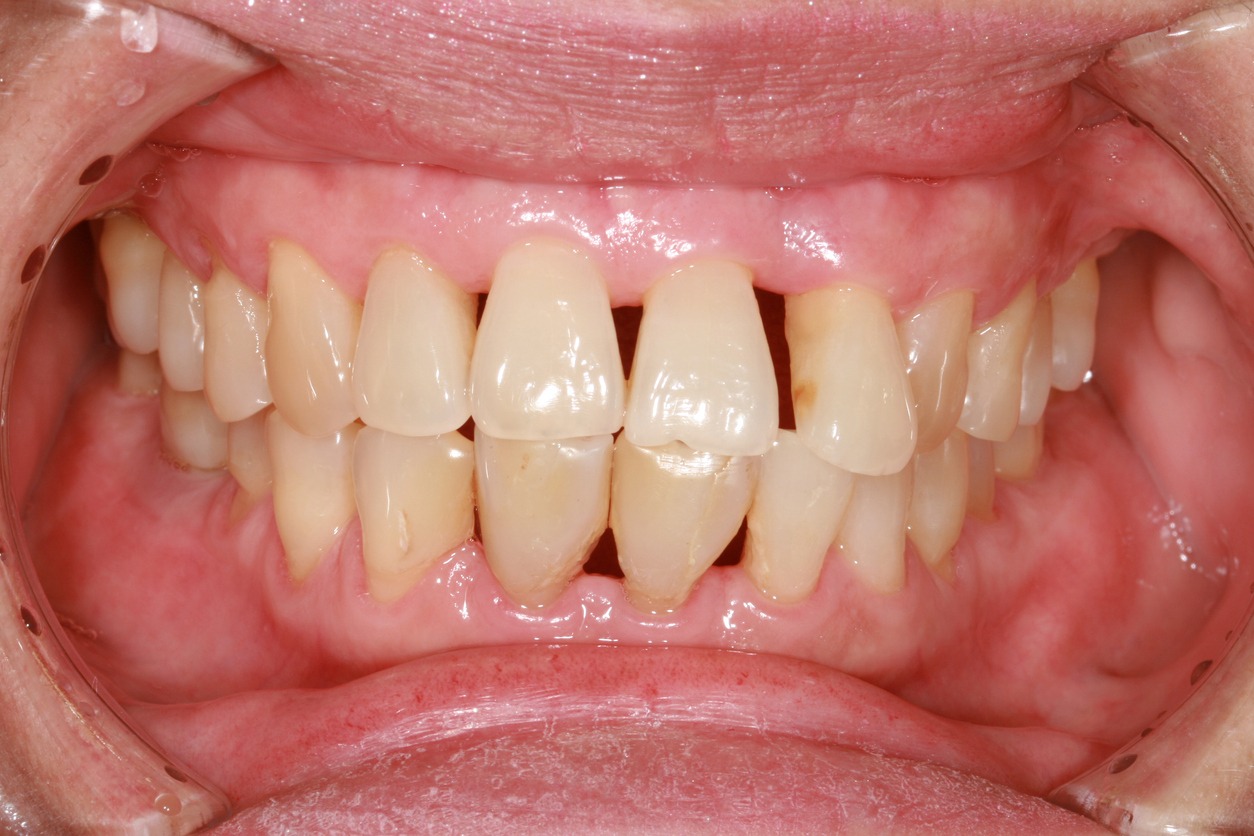 patient with receding gums